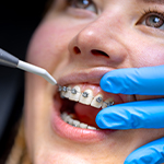 Orthodontic Systems