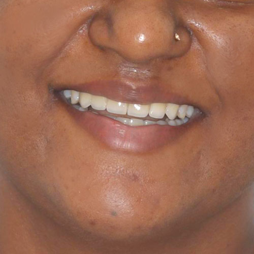 After - smile design