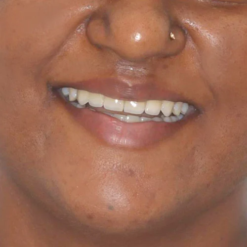 After - smile design