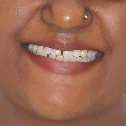 Before - smile design