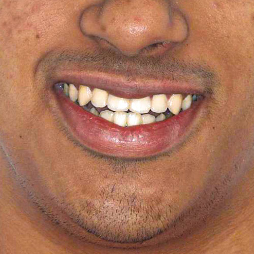 After - Invisalign
