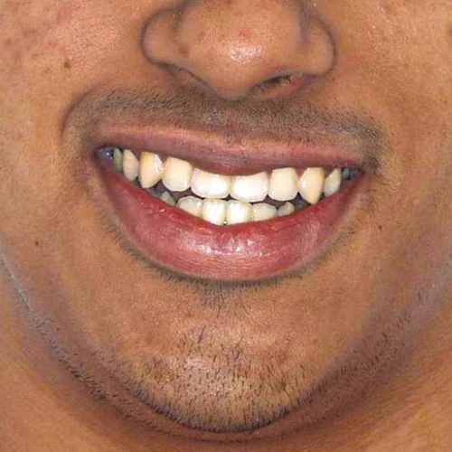 After - Invisalign