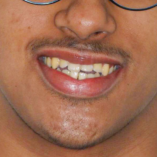 Before - Invisalign